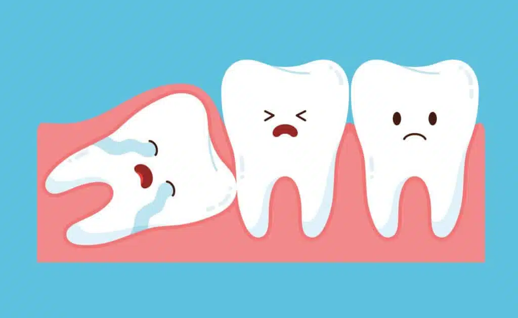 Wisdom Teeth Removal Cost & Recovery Hong Kong - Nixon Dental